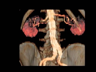 ENDOLEAK Type I-II-III-IV  (Chirurgia Vascolare-ULSS 15 Alta Padovana)