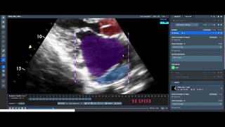Tracking ventricles in Supervisely with AI and Smart Segmentation