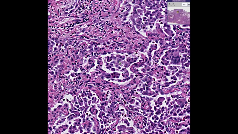 Lung Desquamative interstitial