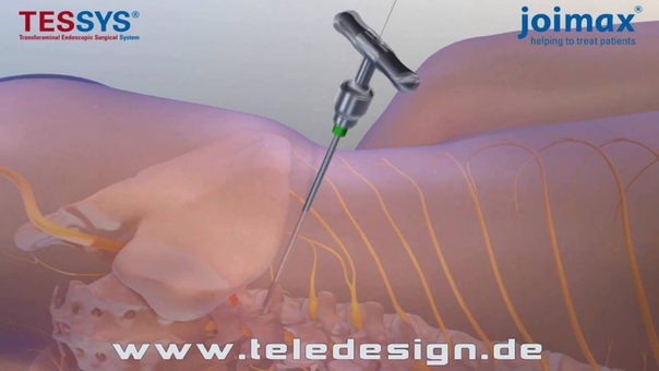 DB 116 Bandscheiben Operation PAL 16:9, DB 116 Disc Surgery PAL