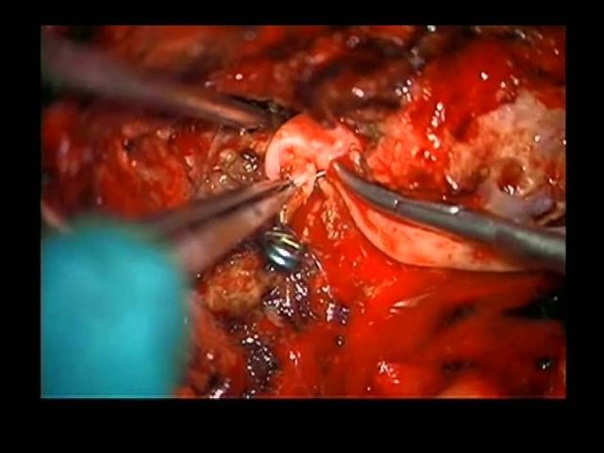 Bypass for Complex Basilar